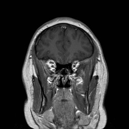 File:Neuro-Behcet's disease (Radiopaedia 21557-21505 Coronal T1 C+ 3).jpg