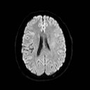 File:Neuro-Behcet's disease (Radiopaedia 21557-21506 Axial DWI 17).jpg
