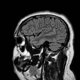 File:Neuro-Behcet's disease (Radiopaedia 21557-21506 Sagittal FLAIR 29).jpg