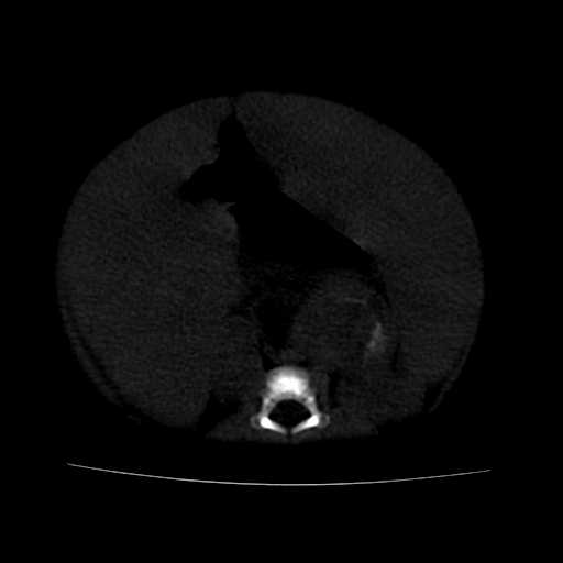 File:Neuroblastoma (Radiopaedia 20876-20799 Axial bone window 14).jpg