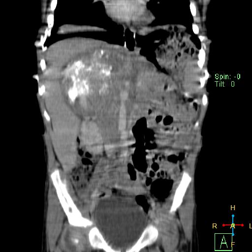 File:Neuroblastoma (Radiopaedia 24751-25016 B 13).jpg