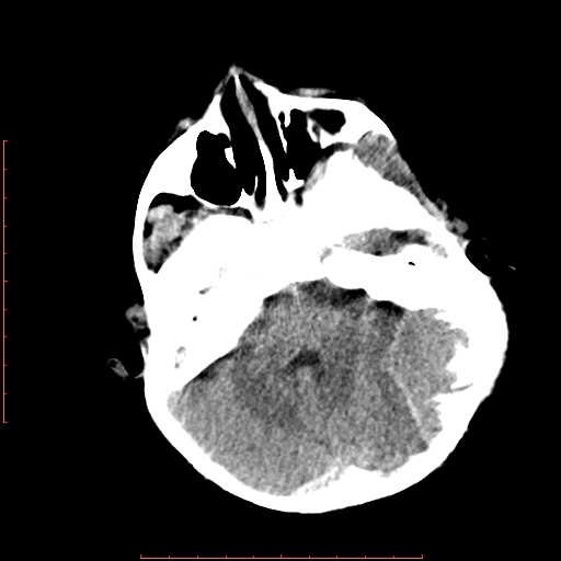 File:Neuroblastoma skull metastasis (Radiopaedia 56053-62683 Axial non-contrast 5).jpg