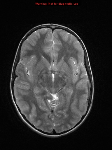 File:Neurofibromatosis type 1 with optic nerve glioma (Radiopaedia 16288-15965 Axial T2 14).jpg