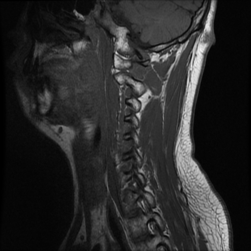 File:Neurofibromatosis type 2 (Radiopaedia 44936-48837 Sagittal T1 5).png