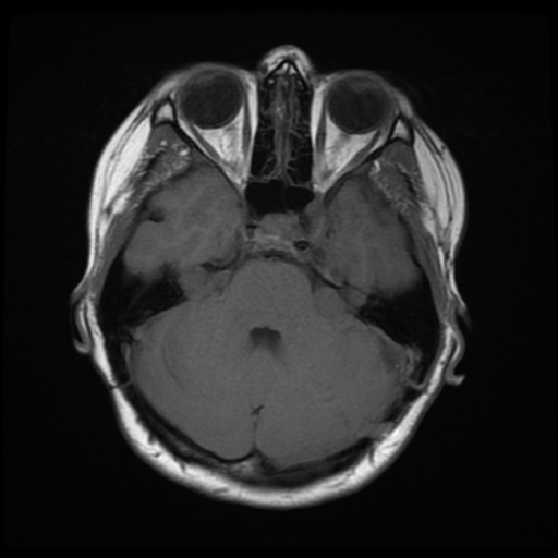 File:Neurofibromatosis type 2 (Radiopaedia 45229-49247 Axial T1 7).png