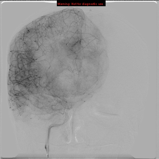 File:Neurofibromatosis type 2 (Radiopaedia 8953-9733 D 13).jpg