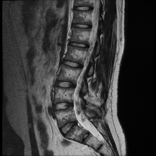 File:Neurofibromatosis type 2 (spinal manifestations) (Radiopaedia 53943-60070 E 9).png