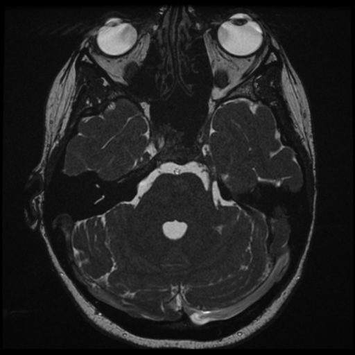 Neurofibromatosis type 2 - bilateral acoustic neuromata (Radiopaedia 40060-42566 Axial FIESTA 51).png