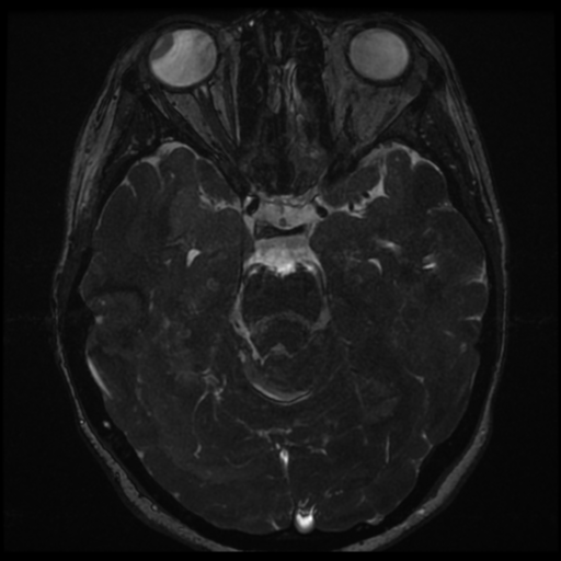 Neurofibromatosis type 2 - bilateral acoustic neuromata (Radiopaedia 40060-42566 Axial FIESTA 76).png