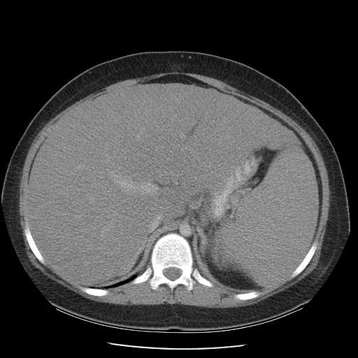 File:Non-Hodgkin lymphoma involving pelvis (Radiopaedia 21281-21197 A 21).jpg