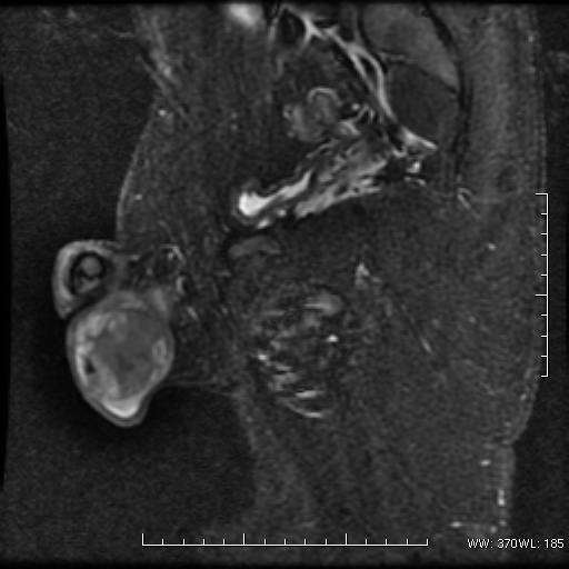 File:Non-seminomatous germ cell tumor (Radiopaedia 16649-16352 Sagittal T2 fat sat 6).png