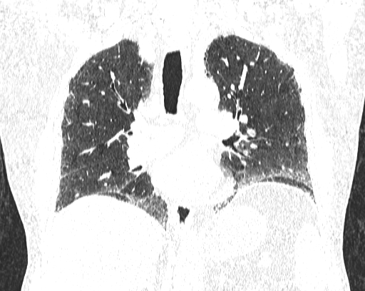 Non-specific interstitial pneumonia (NSIP) (Radiopaedia 68599-78228 Coronal lung window 51).jpg