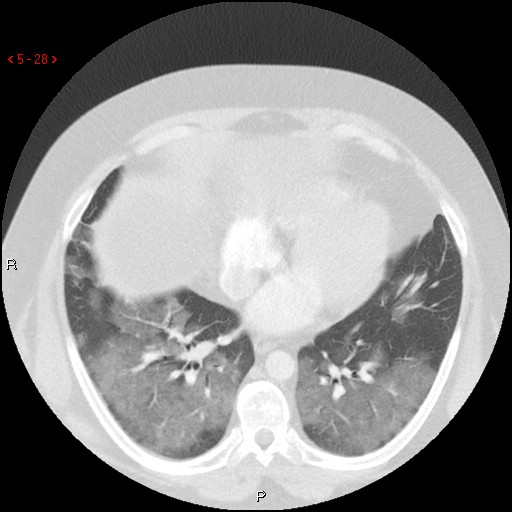 File:Non-specific interstitial pneumonitis (Radiopaedia 27044-27222 Axial lung window 19).jpg