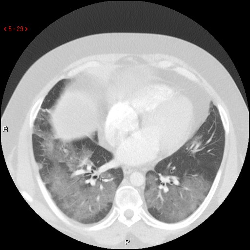 File:Non-specific interstitial pneumonitis (Radiopaedia 27044-27222 Axial lung window 20).jpg