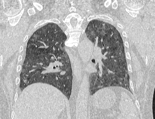 Non specific interstitial pneumonia (NSIP) (Radiopaedia 89725-106798 Coronal lung window 48).jpg