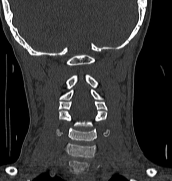 File:Normal CT cervical spine - 12-year-old (Radiopaedia 55352-61775 Coronal bone window 127).jpg
