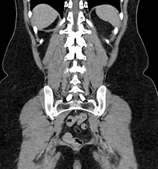 Normal CT intravenous urogram (Radiopaedia 39444-41759 A 348).jpg