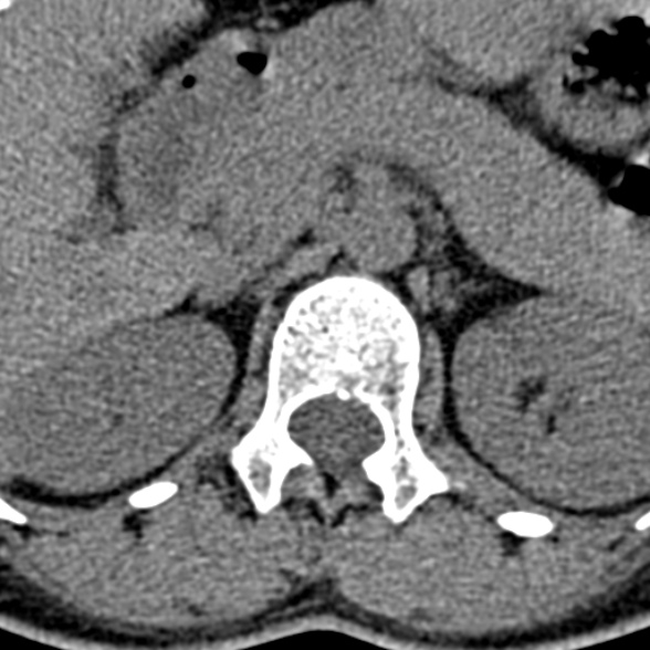 Normal CT lumbar spine (Radiopaedia 53981-60118 Axial non-contrast 16).jpg