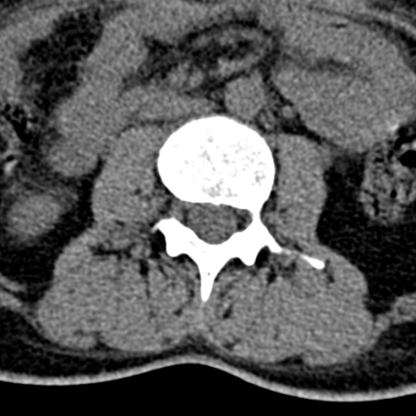 Normal CT lumbar spine (Radiopaedia 53981-60118 Axial non-contrast 50).jpg