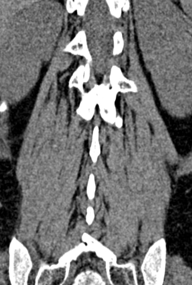Normal CT lumbar spine (Radiopaedia 53981-60118 F 74).jpg