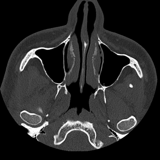 Normal CT paranasal sinuses (Radiopaedia 42286-45390 Axial bone window 80).jpg