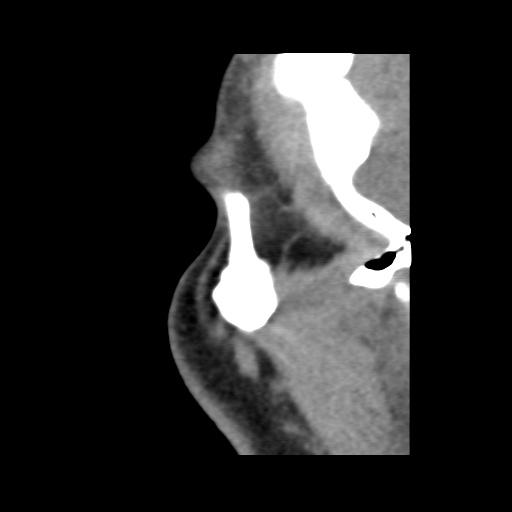 Normal CT paranasal sinuses (Radiopaedia 42286-45390 F 133).jpg