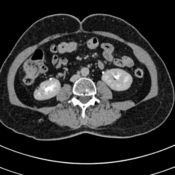 File:Normal CT split bolus study of the renal tract (Radiopaedia 48631-53634 Axial split bolus 134).jpg