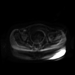Normal MRI abdomen in pregnancy (Radiopaedia 88001-104541 Axial DWI 87).jpg