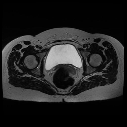 Normal MRI abdomen in pregnancy (Radiopaedia 88005-104548 Axial T2 39).jpg