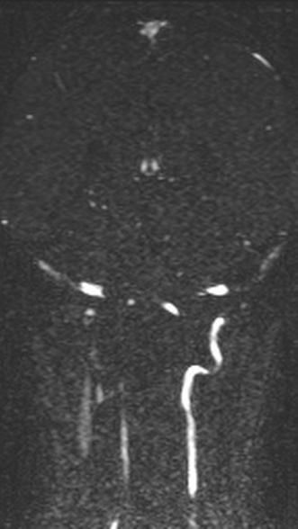 Normal MRI brain with MRV- teenager (Radiopaedia 49425-54553 Coronal MRV 159).jpg