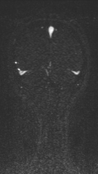 Normal MRI brain with MRV- teenager (Radiopaedia 49425-54553 Coronal MRV 203).jpg