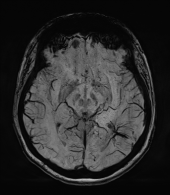 Normal MRI internal auditory canal (Radiopaedia 41613-44525 Axial SWI MIP 36).png