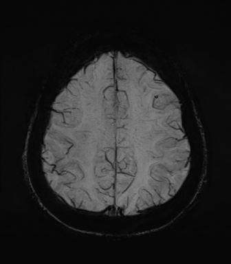 Normal MRI internal auditory canal (Radiopaedia 41613-44525 Axial SWI MIP 60).png