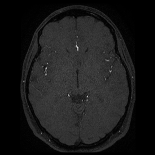 Normal brain MRA (Radiopaedia 41046-43793 Axial MRA 32).png