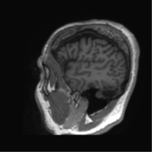 Normal brain MRI (non-focal epilepsy protocol) (Radiopaedia 53917-60040 Sagittal T1 6).png