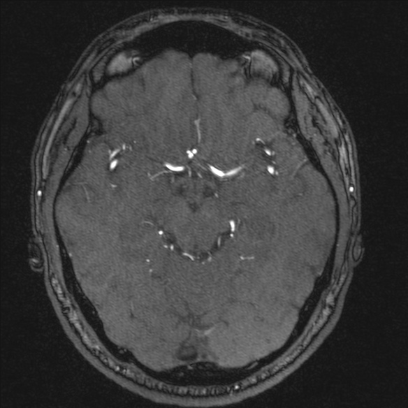 Normal brain MRI including MRA (Radiopaedia 48748-53763 Axial MRA 87).jpg