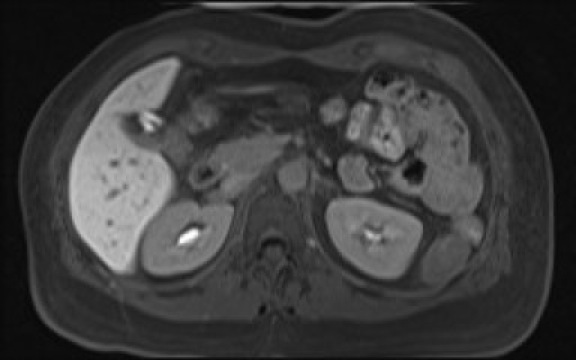 File:Normal hepatobiliary phase liver MRI (Radiopaedia 58968-66230 A 52).jpg