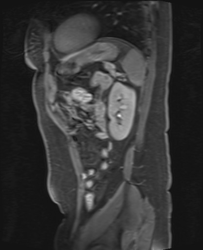 File:Normal hepatobiliary phase liver MRI (Radiopaedia 58968-66230 C 60).jpg