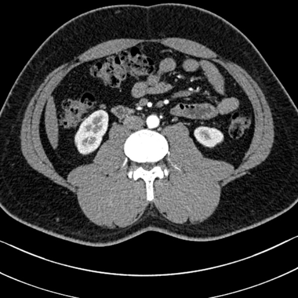 Normal kidneys on 4-phase CT study (Radiopaedia 25889-26038 B 67).jpg