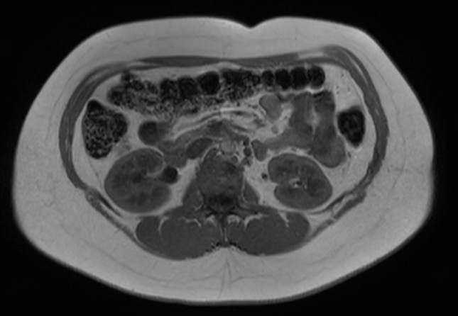File:Normal liver MRI with Gadolinium (Radiopaedia 58913-66163 Axial T1 in-phase 11).jpg