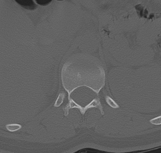 File:Normal lumbosacral CT (Radiopaedia 37923-39867 Axial bone window 23).png