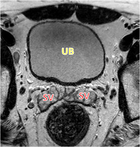 File:Normal prostate (MRI) (Radiopaedia 29986-30536 B 1).png