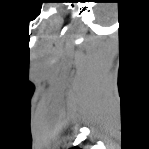 File:Normal trauma cervical spine (Radiopaedia 41017-43760 B 2).png