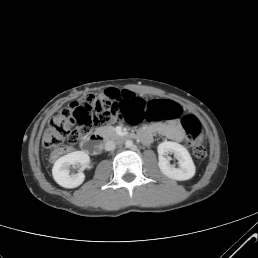 File:Nutmeg liver- Budd-Chiari syndrome (Radiopaedia 46234-50635 B 30).png
