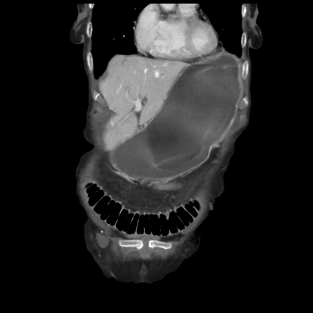 Obstructed obturator hernia (Radiopaedia 75197-86293 B 12).jpg