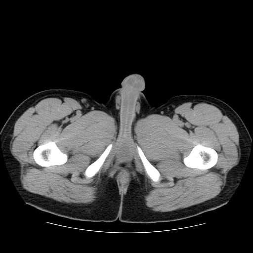 File:Obstructing ureteric calculus (Radiopaedia 18615-18514 Axial non-contrast 62).jpg