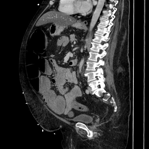 Obstructive colonic diverticular stricture (Radiopaedia 81085-94675 C 134).jpg