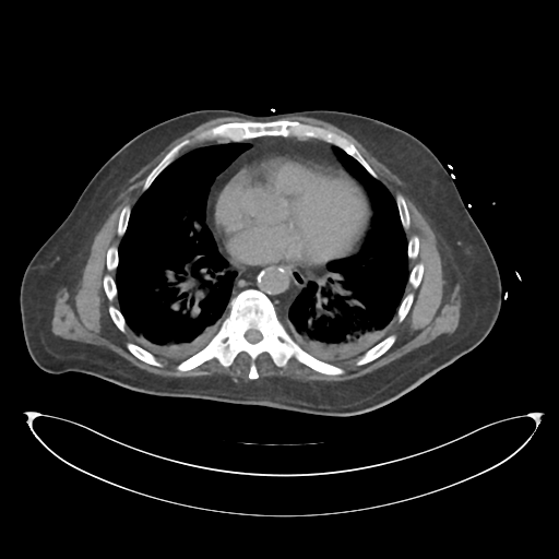 File:Obstructive pyelonephritis (Radiopaedia 46411-50844 Axial non-contrast 4).png
