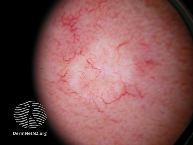 File:White lesion with irregular branched vessels (DermNet NZ morphoeic-bcc-2).jpg