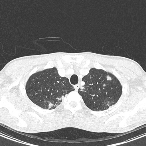 AIDS-related Kaposi sarcoma (Radiopaedia 85247-100811 Axial lung window 26).jpg